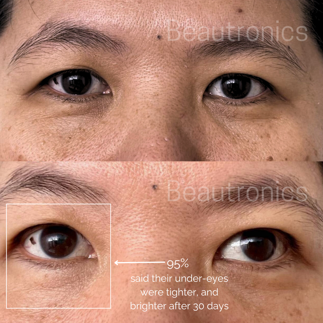 Beautronics Under-Eye Restore System